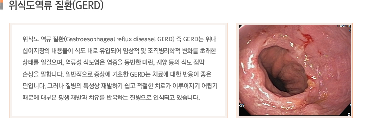 위식도역류 질환(GERD)  